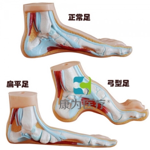 “康為醫(yī)療”正常足、扁平足、弓型足模型