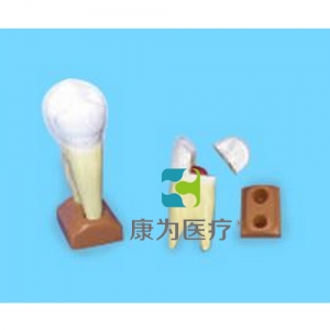 “康為醫(yī)療”上頜兩根齲齒模型(2部分，放大)