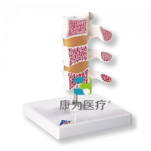 豪華型骨質(zhì)疏松癥模型，3塊椎骨